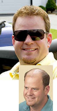 Male Hair Loss Replacement - Moline, Illionois - Davenport, Iowa