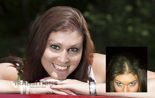 Laser Hair Therapy Solutions Men Women Transitions Hair